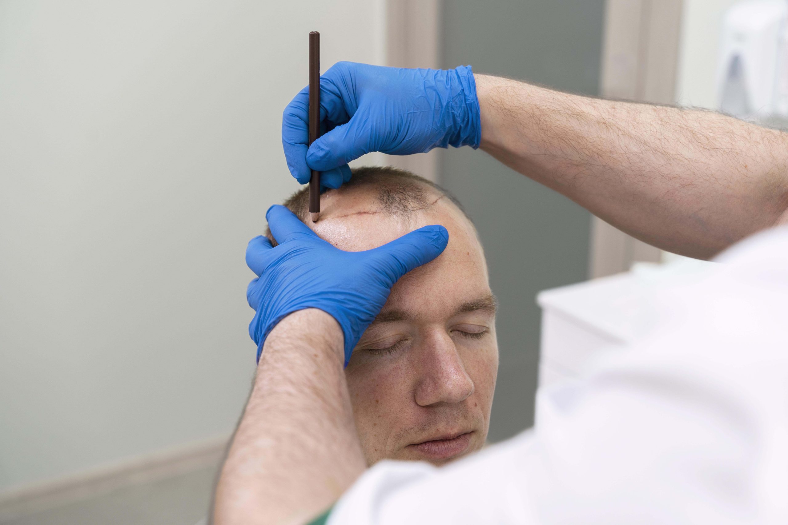 What is the Best Hair Transplant Clinic in Istanbul scaled