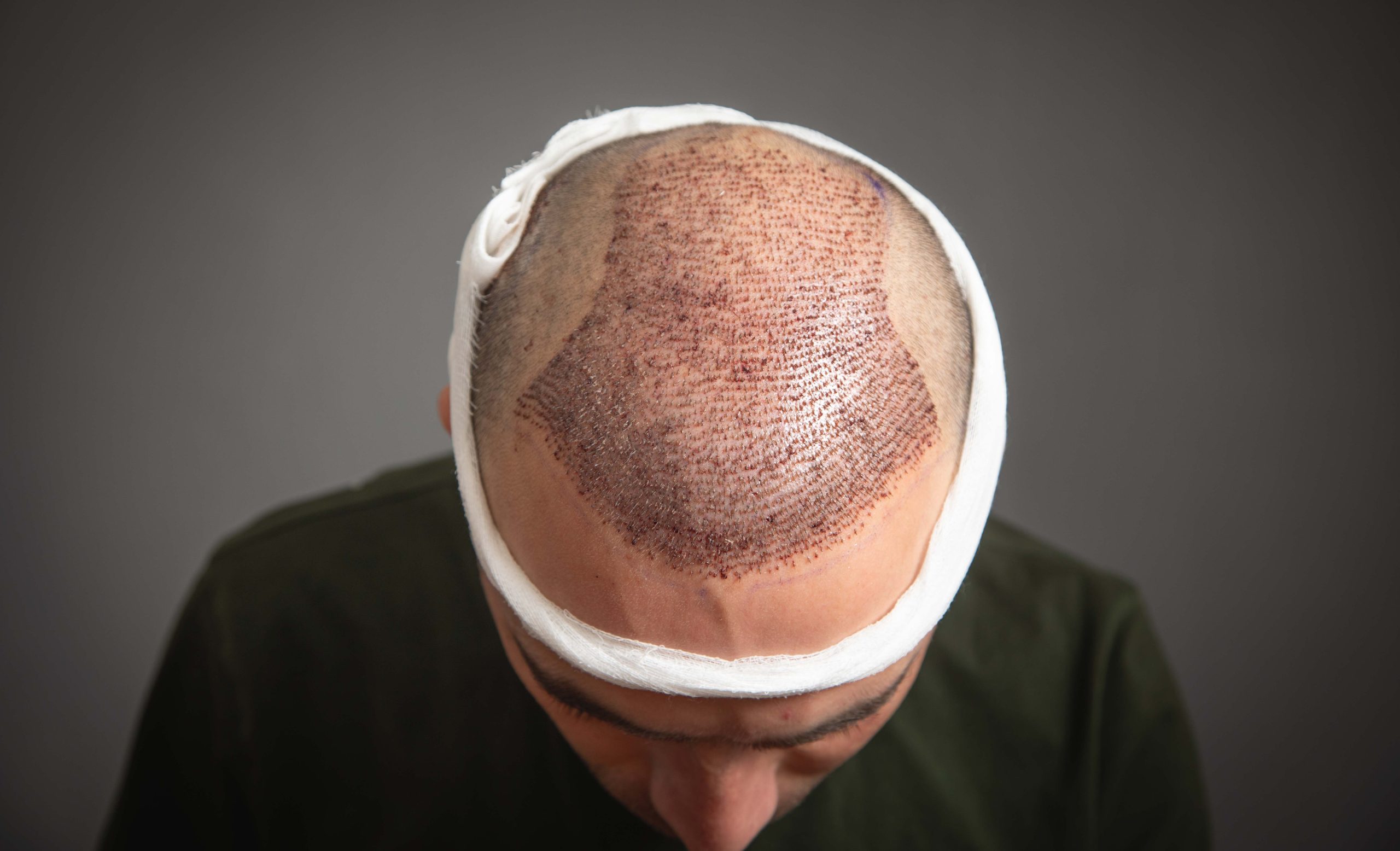 Why Istanbul for Hair Transplantation scaled